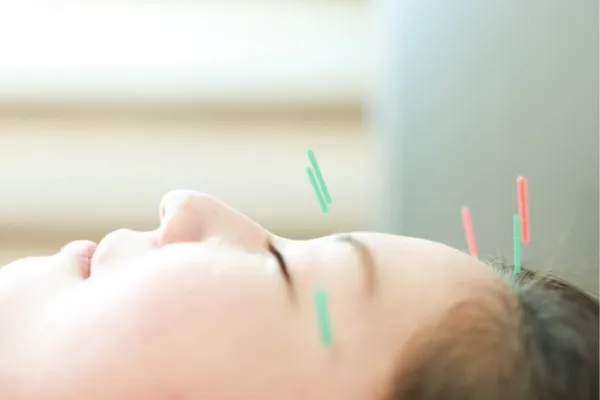 お顔の鍼コース